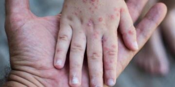 En el país hay 43 casos de sarampión, todos ellos importados: Ssa