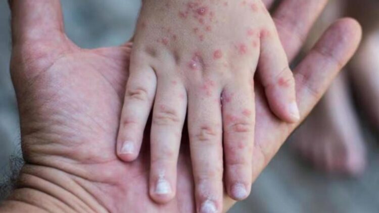 En el país hay 43 casos de sarampión, todos ellos importados: Ssa