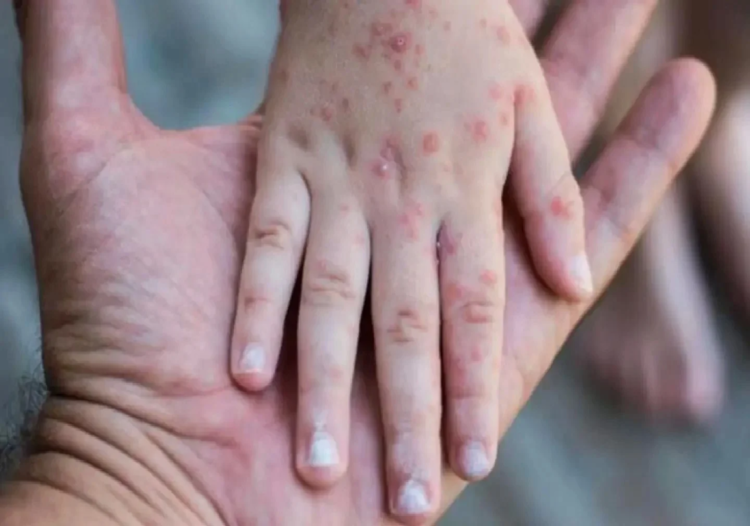 En México hay actualmente 362 casos de sarampión; Ssa reporta un deceso