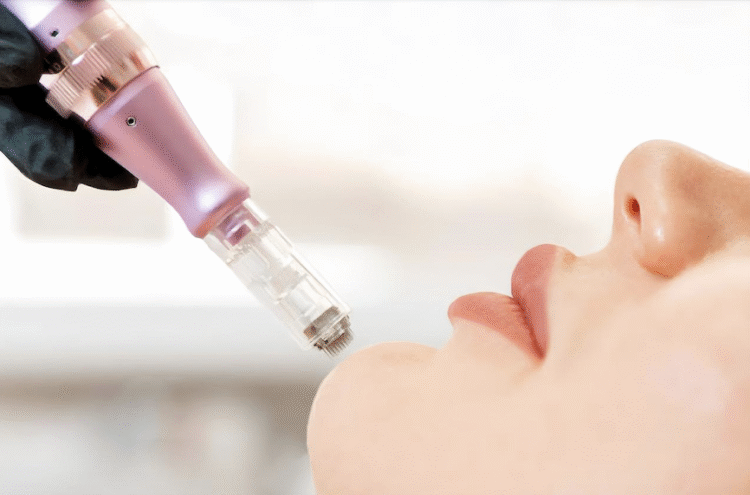 La revolución en el cuidado de la piel: Derma Pen, el secreto para una piel radiante