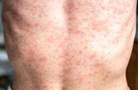 Confirman 4 mil 353 casos y 17 muertes por sarampión en México