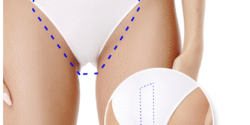 Kopay: depilación láser de barba, axilas y bikini en tendencia