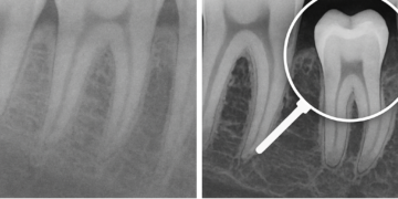 Dentistas digitales en México: planificación 3D para implantes más precisos y mejor diagnóstico