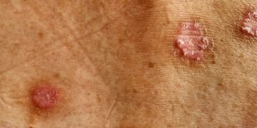 31 millones de personas en México viven con alguna enfermedad de la piel. ¿Cómo reconocer la Hidradenitis Supurativa?