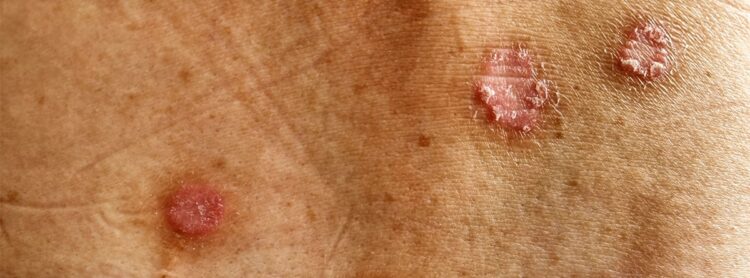 31 millones de personas en México viven con alguna enfermedad de la piel. ¿Cómo reconocer la Hidradenitis Supurativa?