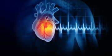 El 44% de los pacientes de Infarto Cerebral podrían padecer secuelas